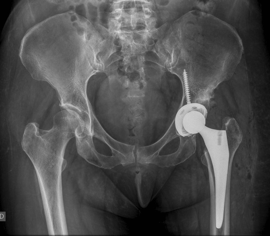 Radiografía postoperatoria de pelvis con prótesis total de cadera izquierda no cementada