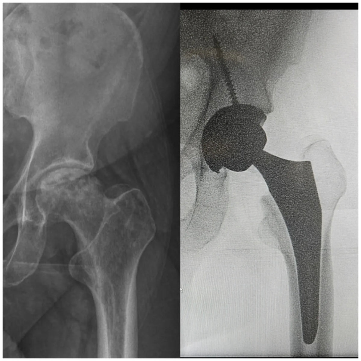 Radiografía antes y después de una prótesis total de cadera