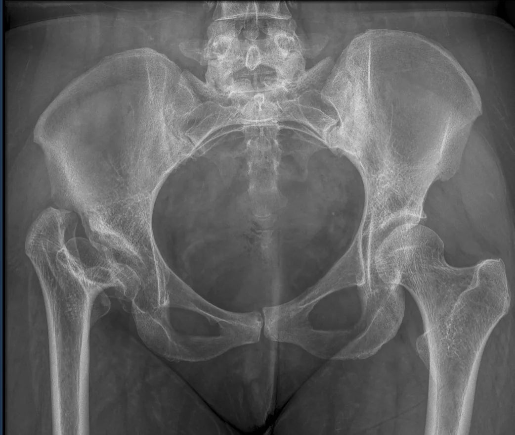 Radiografía anteroposterior de pelvis para el estudio de la displasia de cadera