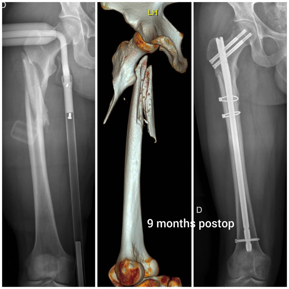 Fractura de cadera subtrocantérica compleja: evolución a nueve meses. Radiografía inicial, planificación por tomografía con reconstrucción 3D y control tras la fijación con clavo cefalomedular. Reducción anatómica, calidad de vida recuperada.