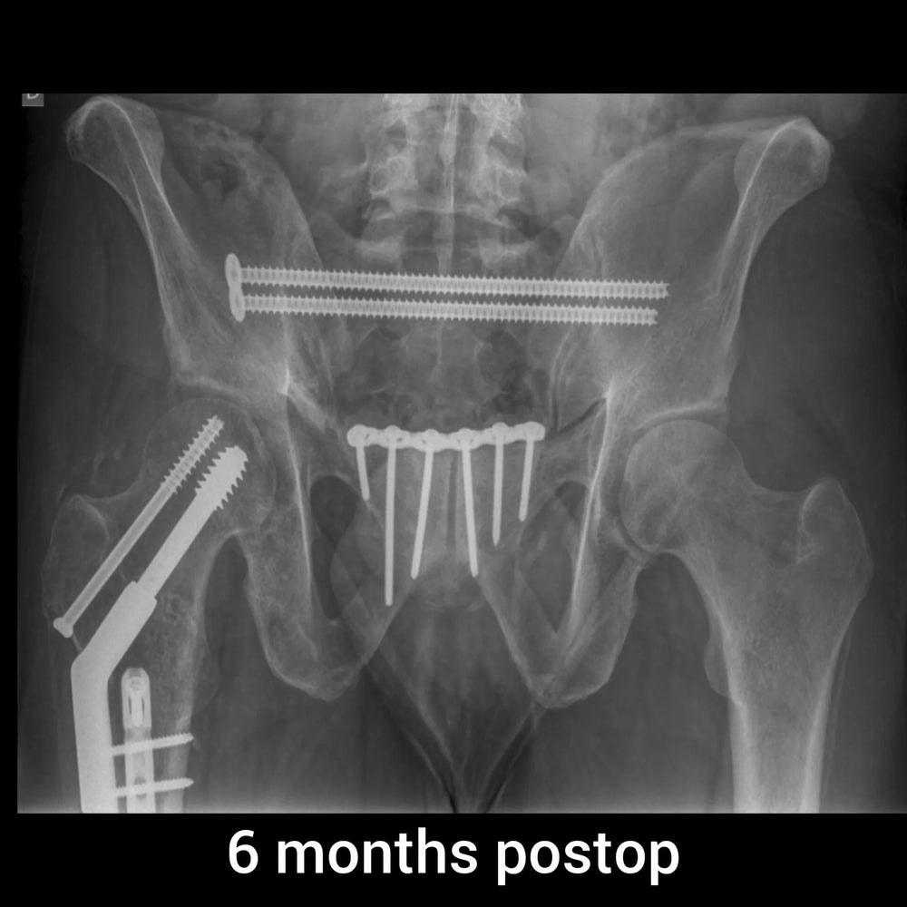 Control a seis meses. Fractura tratada con tornillos sacroilíacos percutáneos y placa. El anillo pélvico recuperó su forma y la fractura consolidó.