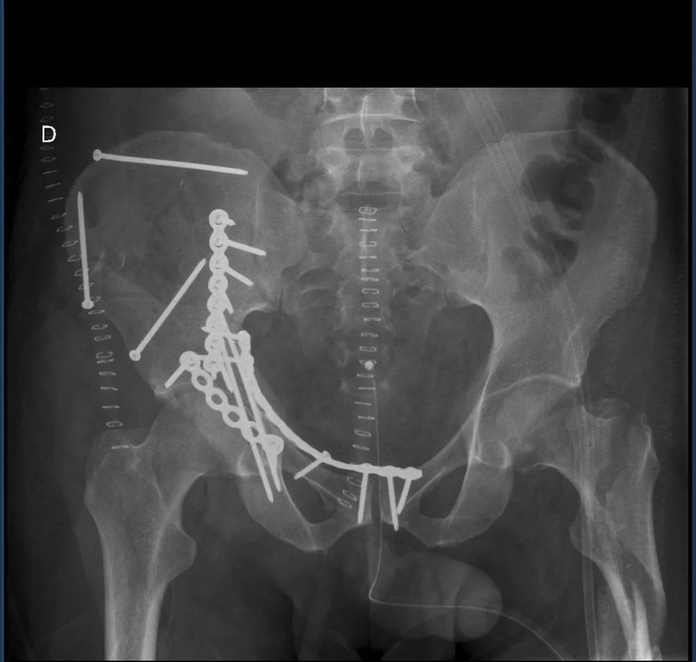 Fractura de acetábulo de dos columnas operada. Esta es una de las fracturas mas complejas que existen. Radiografía postoperatoria de pelvis AP con reducción y fijación de la fractura con múltiples placas y tornillos. En estas lesiones el objetivo es la reducción anatómica para mejorar el pronostico de la articulación.