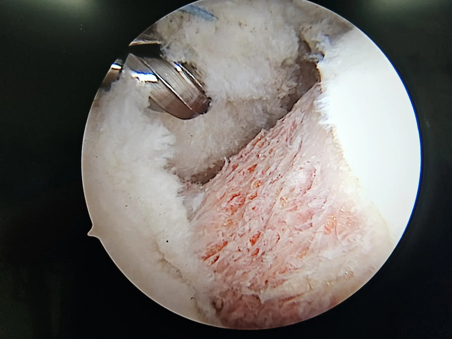 Visión artroscópica del labrum durante una artroscopía de cadera
