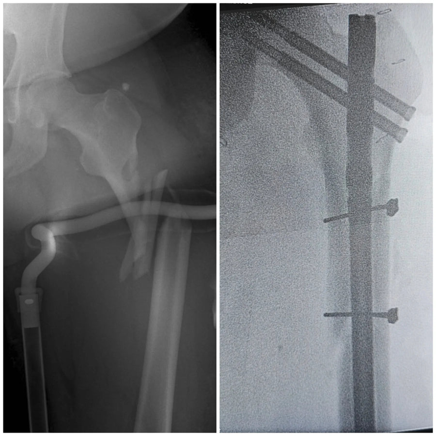 Fractura de cadera antes y después de la osteosíntesis