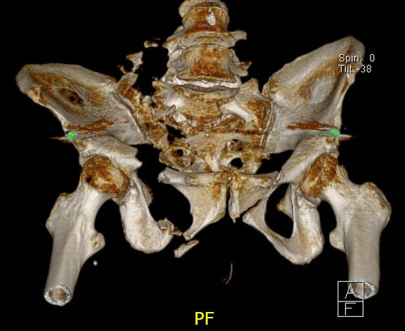 Reconstrucción tridimensional de tomografía preoperatoria de una fractura compleja de pelvis con inestabilidad vertical