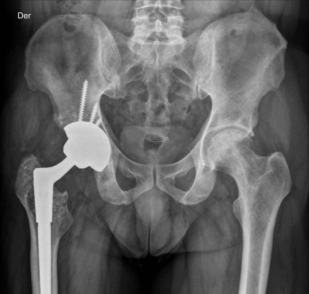 Radiografía de control tras una revisión de prótesis de cadera. En este caso se revisó el cotilo y el vástago femoral.