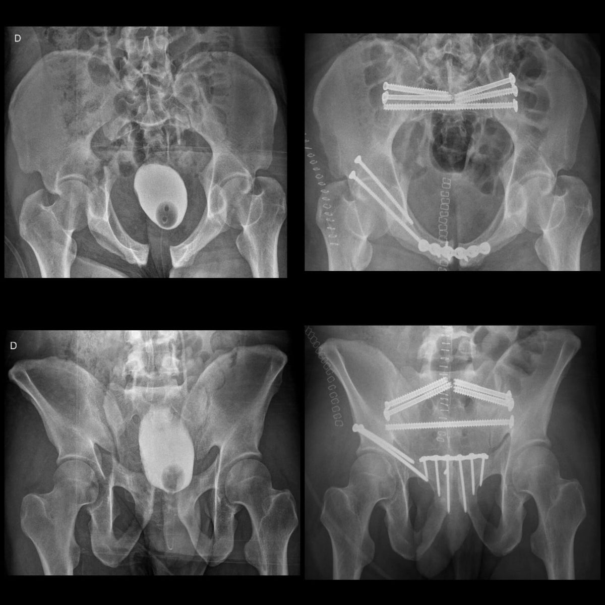 Radiografías pre y postoperatorias de una fractura compleja de pelvis asociada a fractura de acetábulo derecho