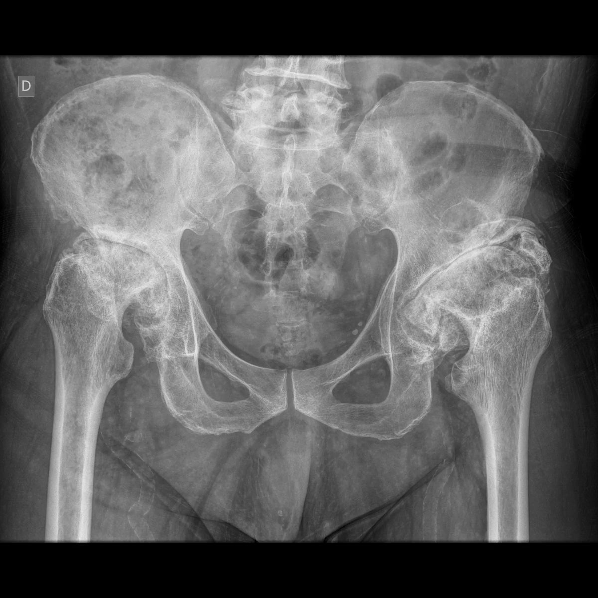 Radiografía de pelvis con displasia severa y artrosis secundaria de ambas caderas