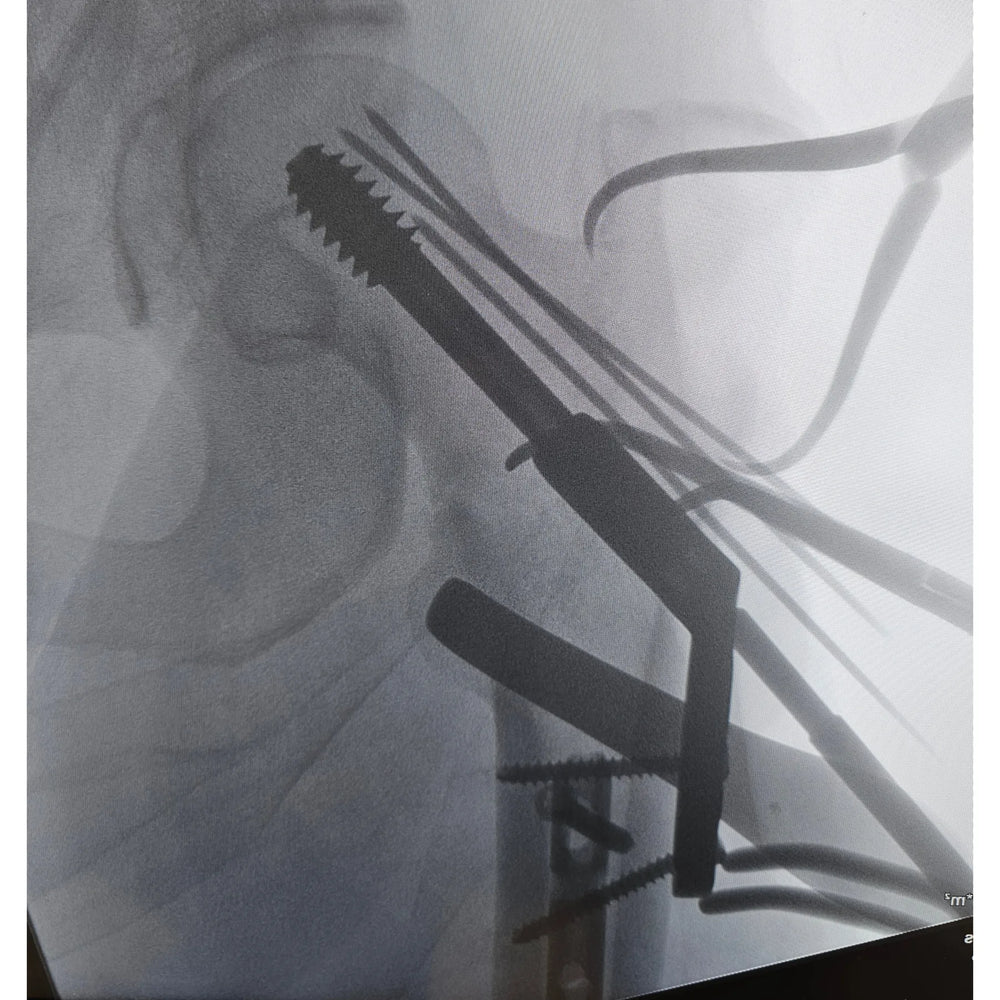 Control radiológico intraoperatorio en una fractura compleja de cadera. El control intraoperatorio permite verificar la calidad de la reducción y que todos los implantes estén en la posición correcta.