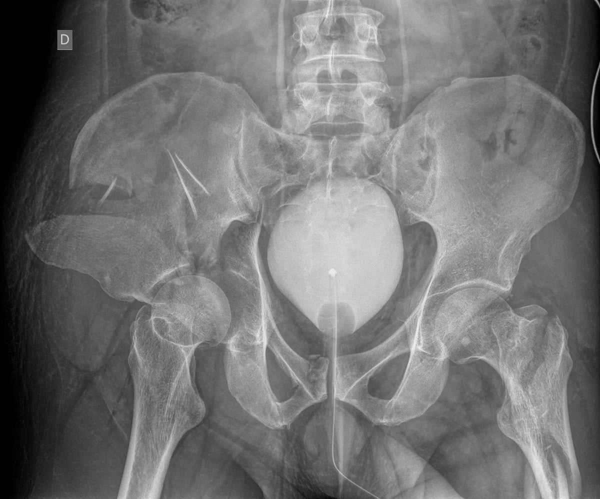 Radiografía de una fractura compleja de acetábulo derecho asociada a una fractura de cadera izquierda.