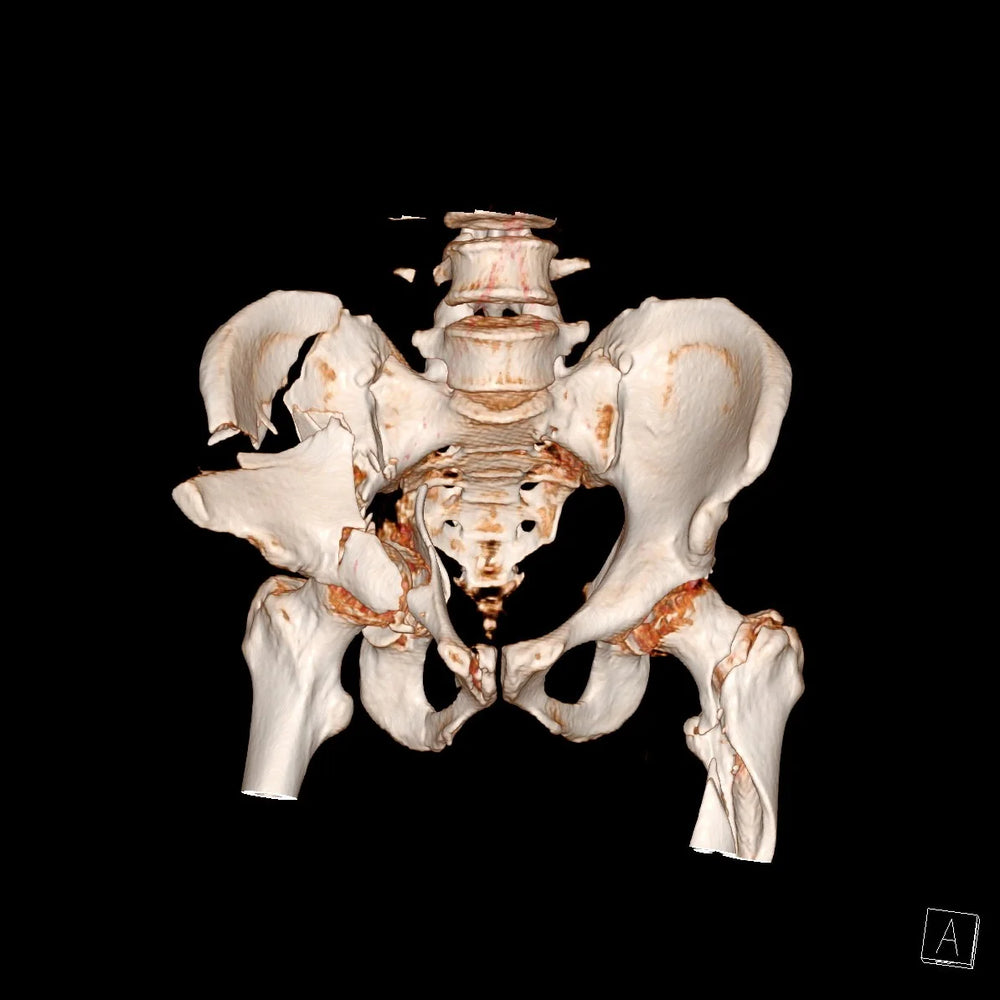 Fractura compleja de pelvis. Reconstrucción tridimensional por tomografía de una fractura del anillo pélvico por trauma de alta energía. El estudio 3D permite entender el desplazamiento de cada fragmento y planificar la vía de abordaje antes de entrar a pabellón.